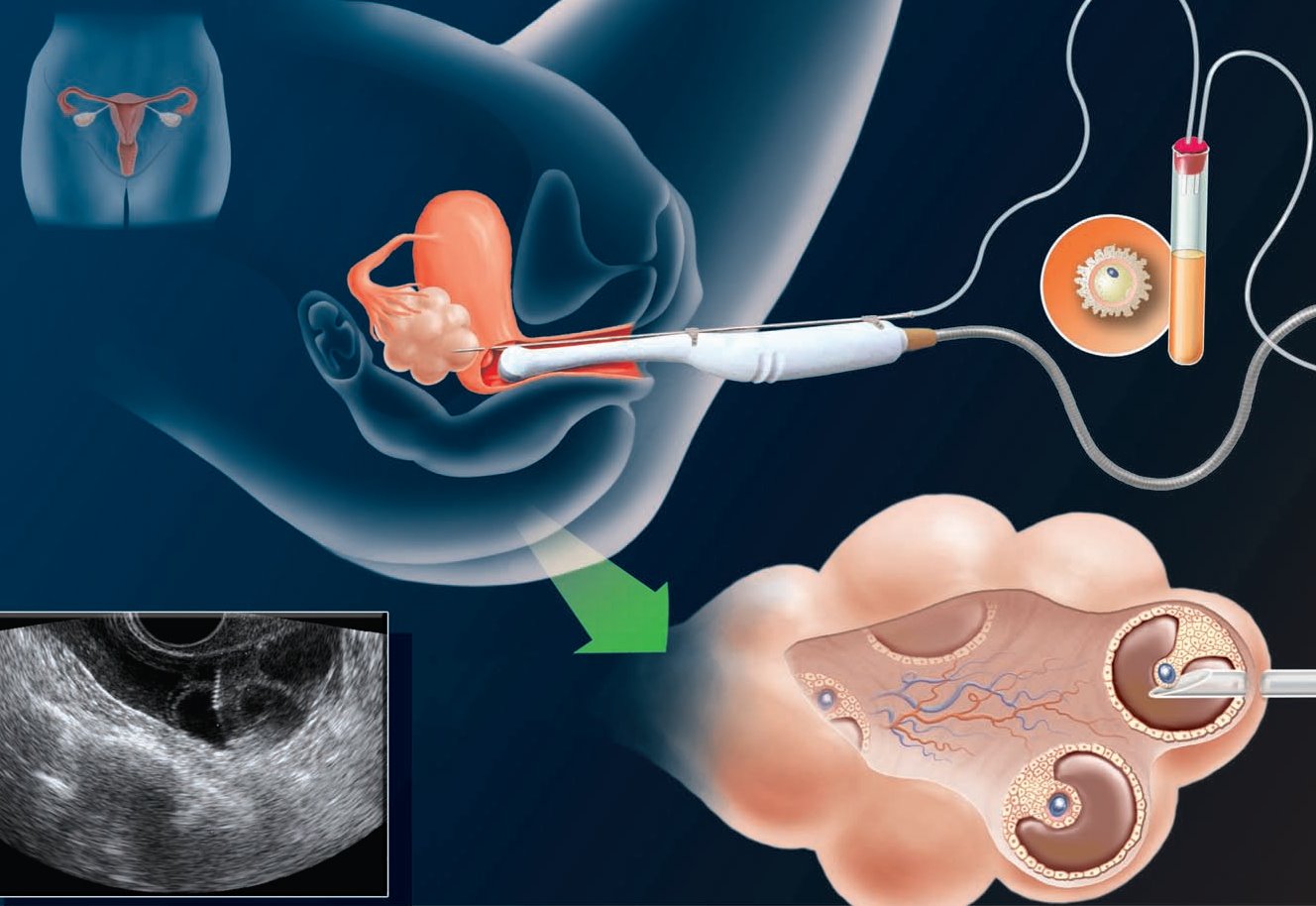 процедура введения спермы в матку фото 24