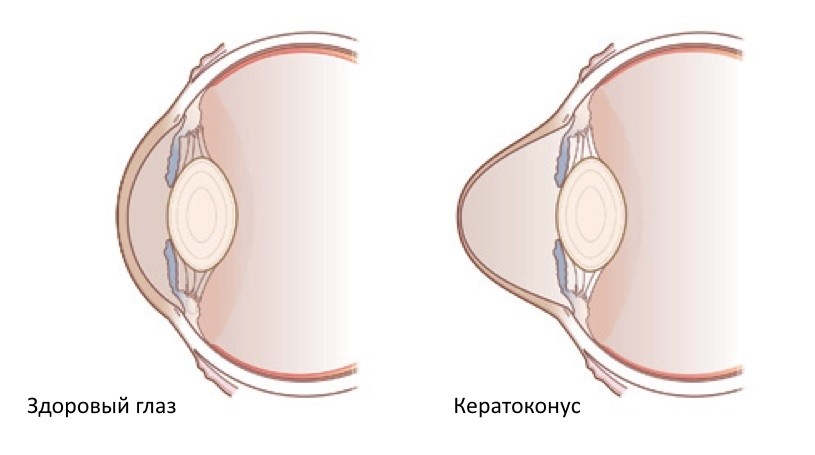 Кератоконус3.jpg