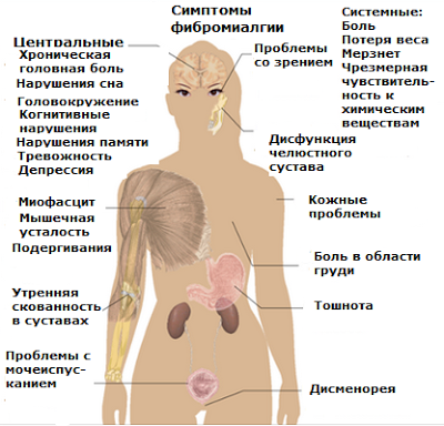 Фибромиалгия2.png