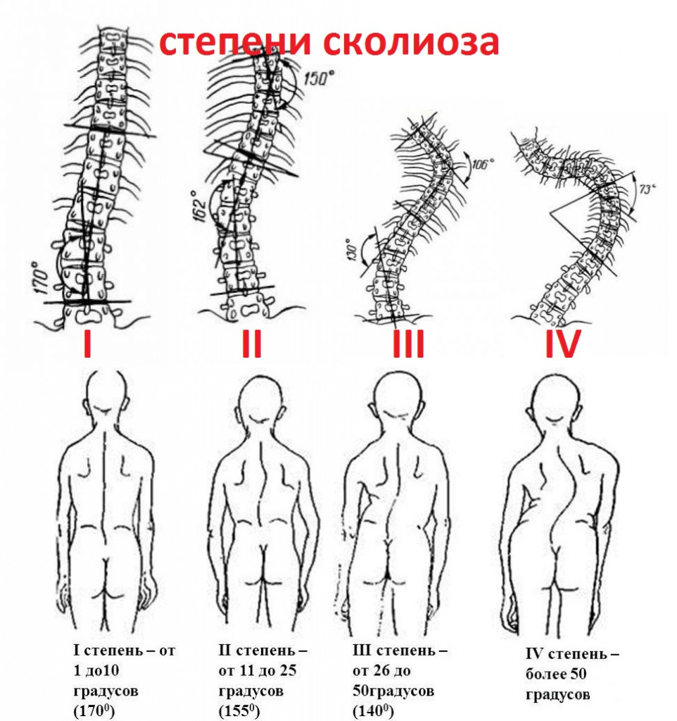 Степени заболевания сколеоза3.jpg