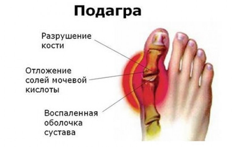 Подагра.jpg