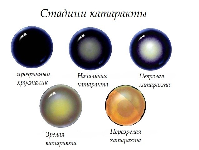 Катаракта3.jpg