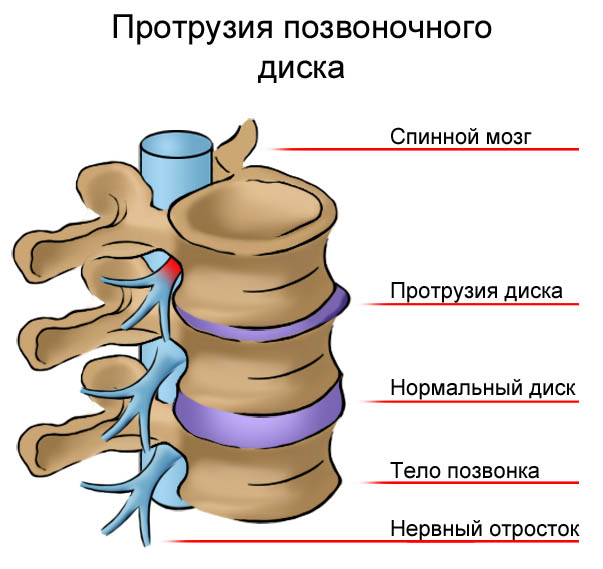 Протрузия межпозвоночного диска