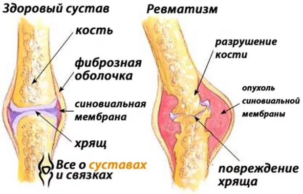Ревматизм лечение3
