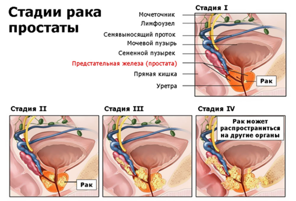 Рак предстательной железы 