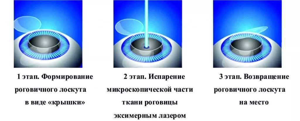 Лазерная коррекция зрения