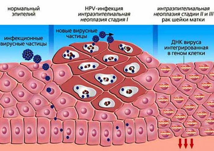 Вирус папилломы человека