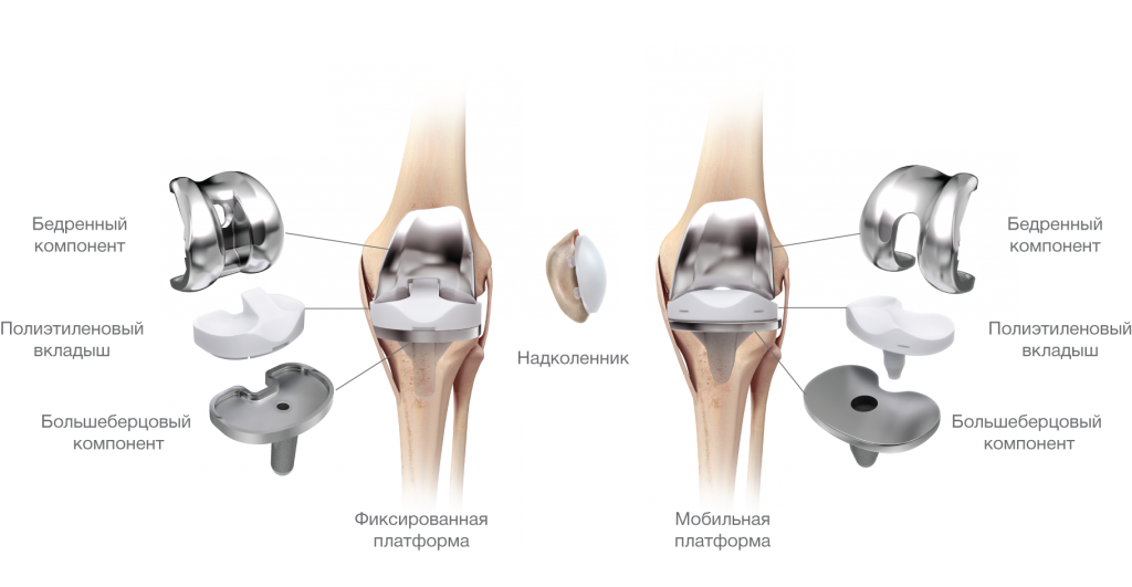 Операция по протезированию коленного сустава.png