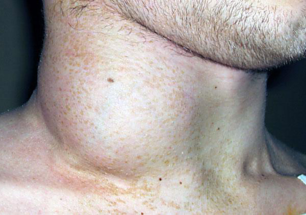  лечения тяжелых форм неходжкинской лимфомы