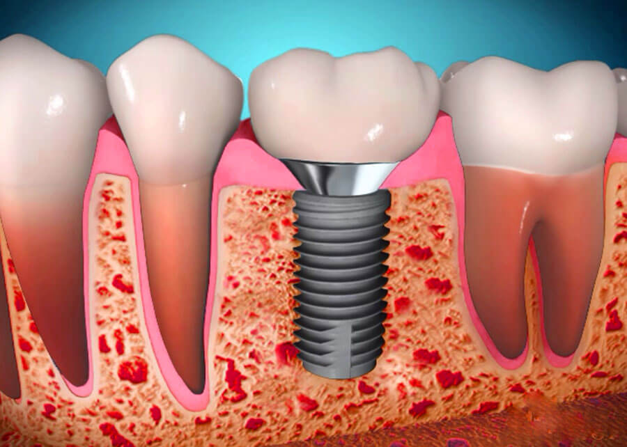 импланты зубов.jpg