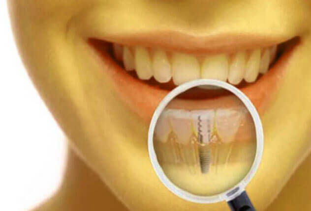 Имплантация зуба.jpg