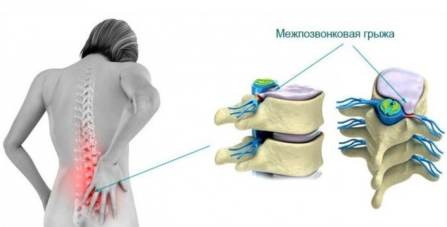 Грыжа межпозвоночного диска