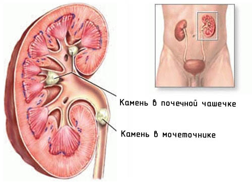 Мочекаменная болезнь.jpg