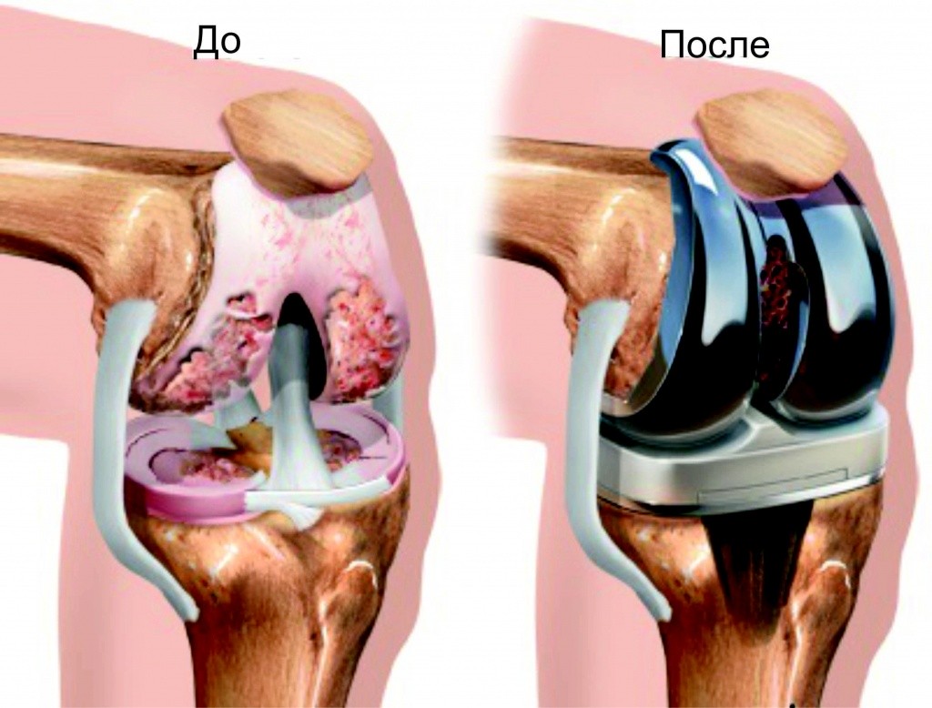 Операция по протезированию коленного сустава.jpg