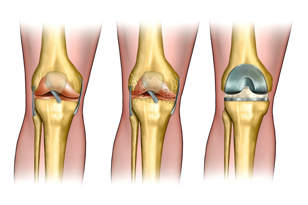 Операция по протезированию коленного сустава2.jpg