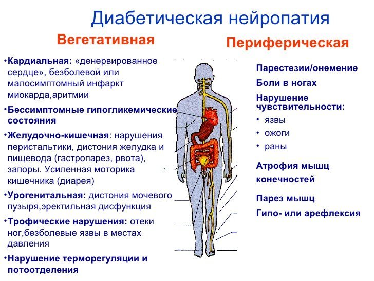 Диабетическая нейропатия.jpg