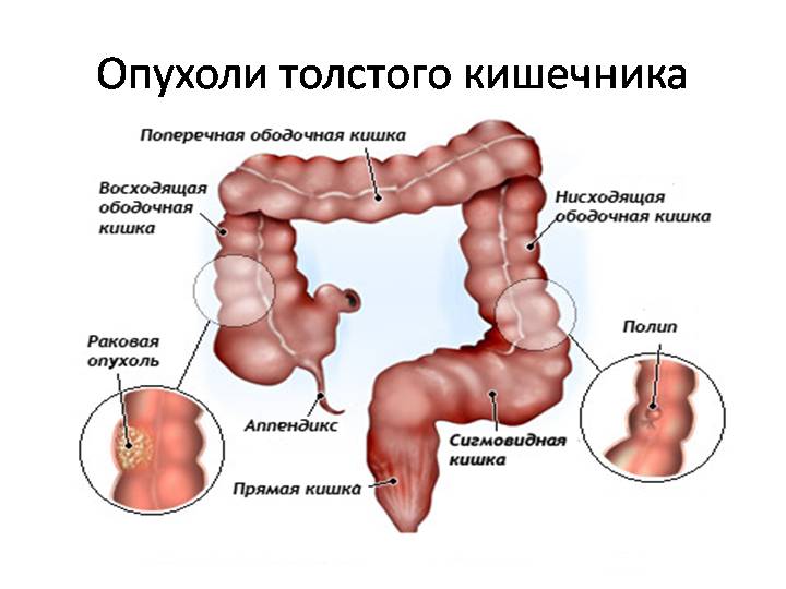 Рак ЖКТ2.jpg