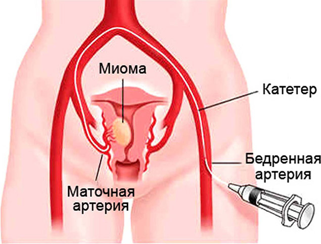 Лечение миомы матки в Израиле