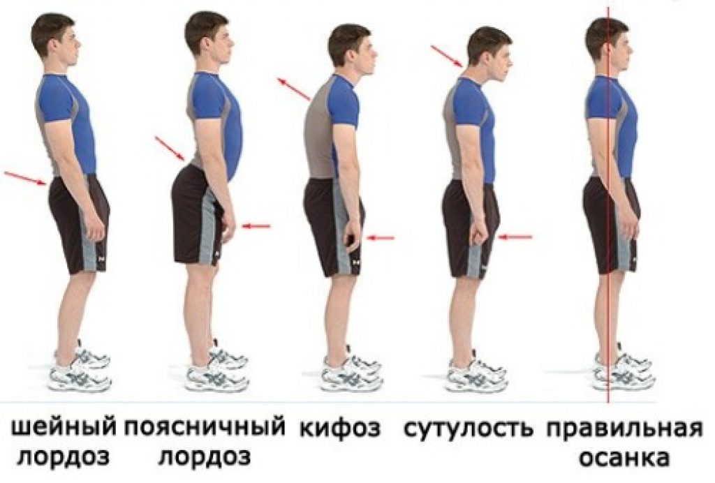 Шейный лордоз классификация