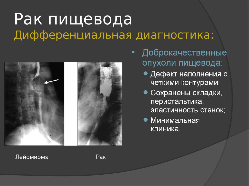 Рак пищевода диагностика