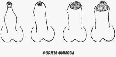 формы фимоз