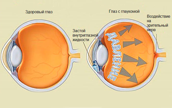 Глаукома.jpg