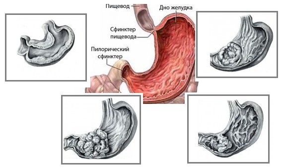 Аденокарцинома2.png