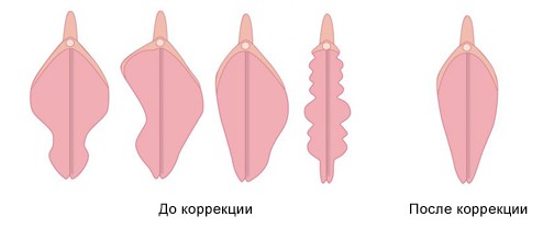 Растяжки малых интимных губ