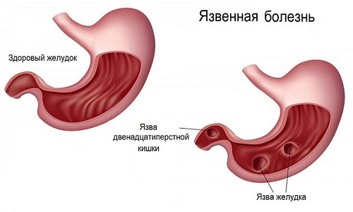 Язва желудка