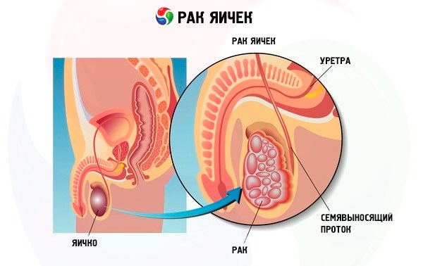 Рак яичек.jpg