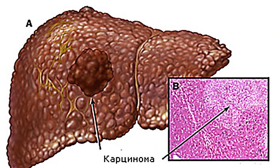 Карцинома3.jpg