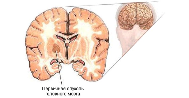 Глиома3.jpg
