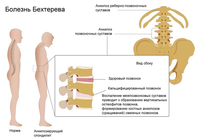 методики при болезни Бехтерева