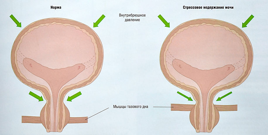 Недержание мочи диагностика и лечение3.jpg