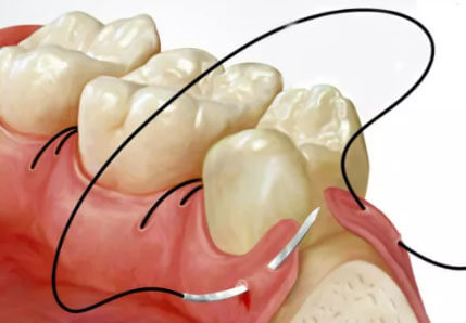 операция на тканях парадонта.jpg