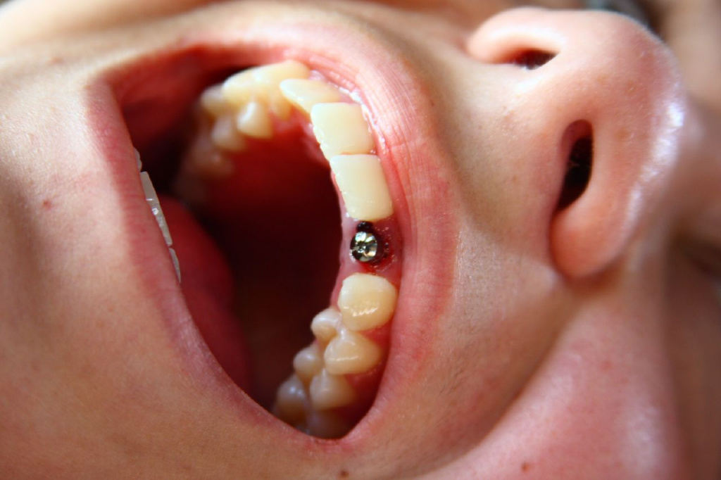 Как проводится имплантация зубов в Израиле? 