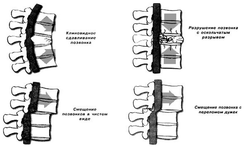 Отдел разрыв. Классификация позвоночно-спинномозговой травмы. Виды переломов спинного мозга. Компрессионный перелом позвонка типы. Осложненные переломы позвонков классификация.