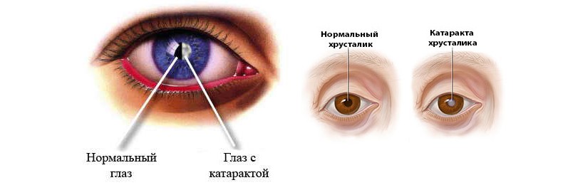 Катаракта2.jpg