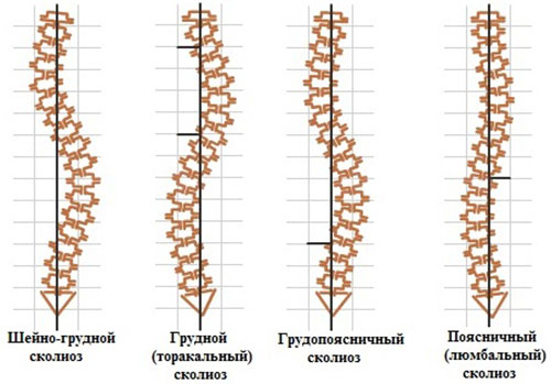Виды нарушений в позвоночнике