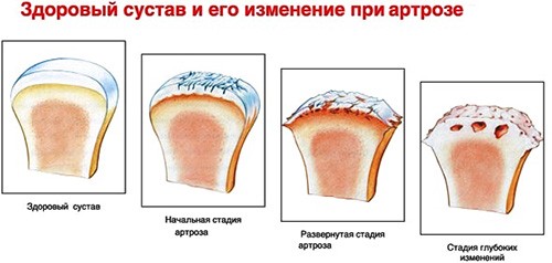 Стадии развития артроза пальцев рук