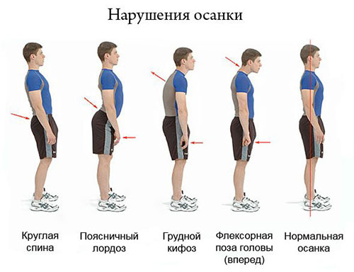 Главная причина развития сколиоза 3 степени - нарушение осанки