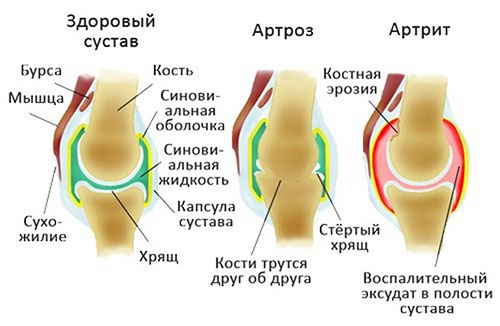 Суставы больного артрозом и артритом