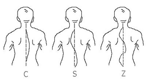 Патологическая деформация позвоночника при сколиозе 4 степени