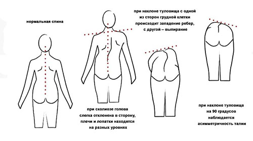 Причины развития сколиоза 3 степени у взрослых и детей