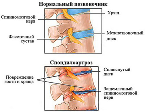 Развитие спондилоартроза