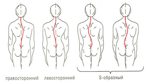 Классификация видов искривления позвоночника