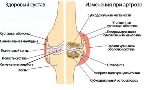Изменения в коленном суставе при артрозе
