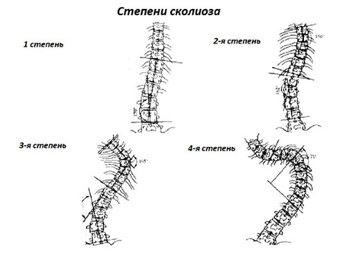 Степени развития сколиоза