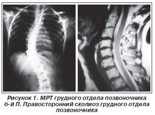 МРТ позвоночника: диагностирование сколиоза 2 степени