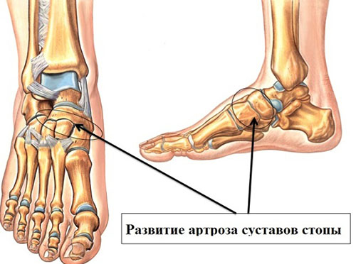 Основные признаки артроза стопы